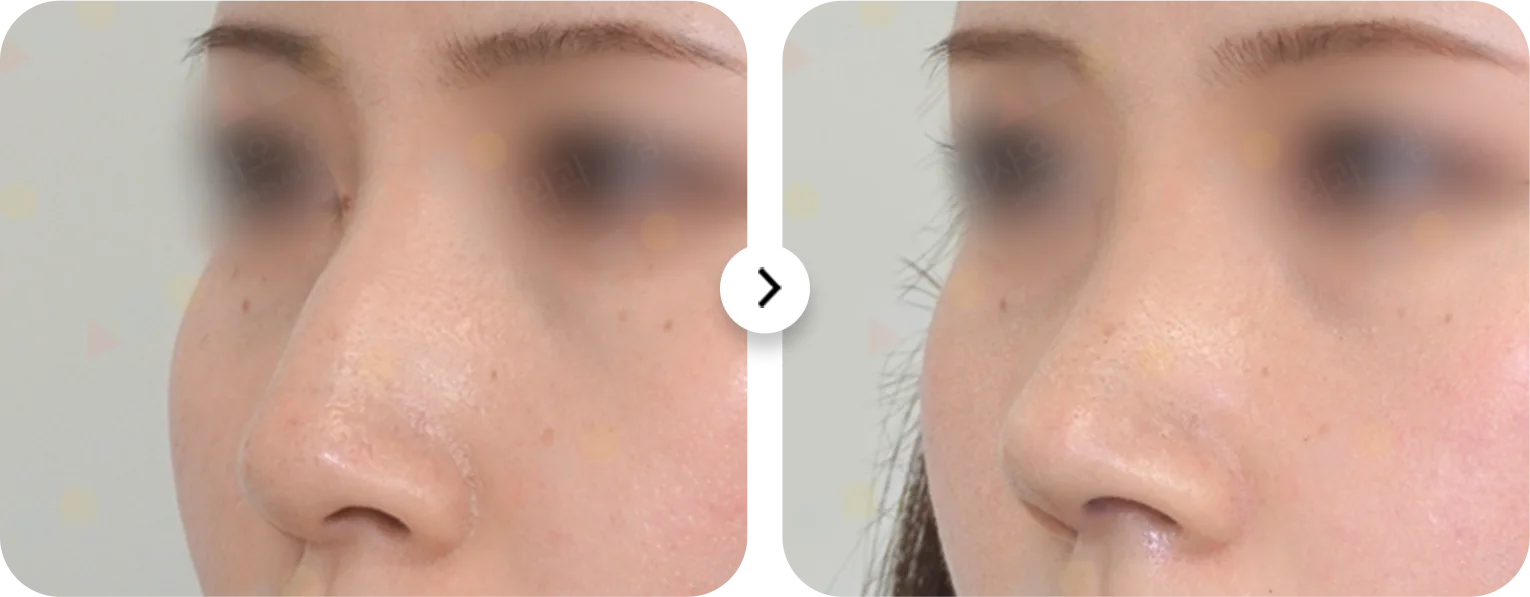 Rhinoplasty before and after. Nose plastic surgery where natural.