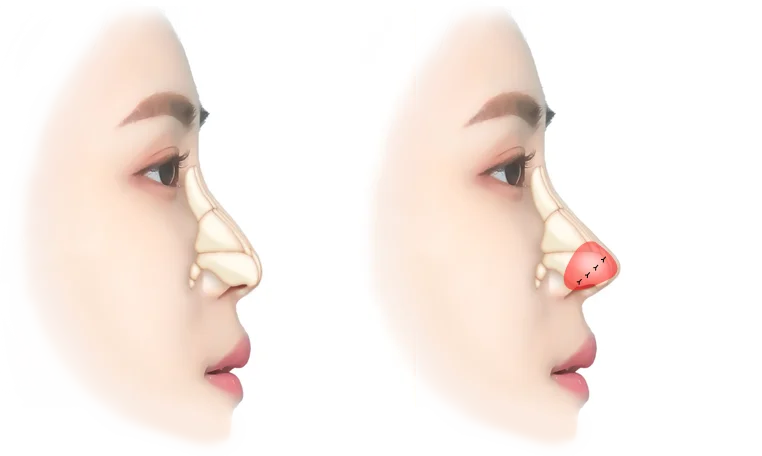 Rhinoplasty before and after 345 plastic surgery where natural nose job for natural results.
