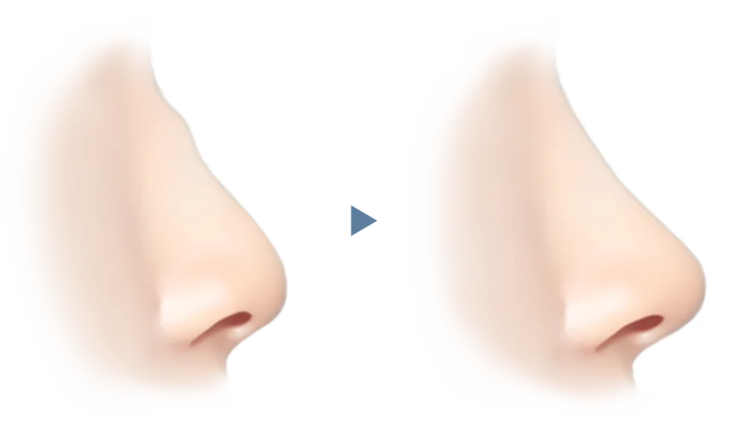 Nose before and after 345 plastic surgery where natural, side view. Plastic surgery illustration.