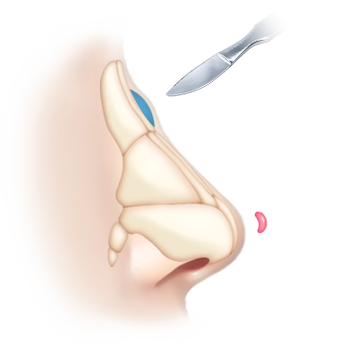 Nose surgery diagram with surgical scalpel