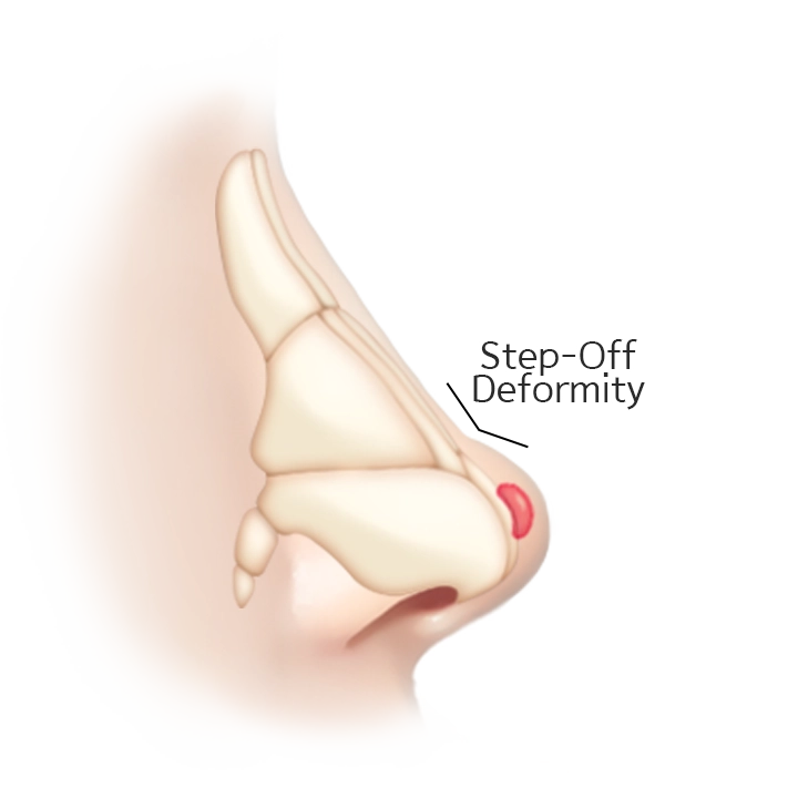 Illustration of nasal step-off deformity.