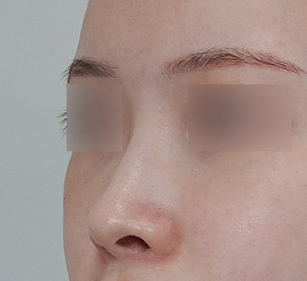 Close up of a nose before 345 plastic surgery where natural