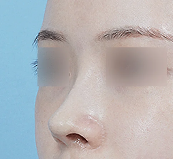 Side view of face with nose. 345 Plastic Surgery where natural.
