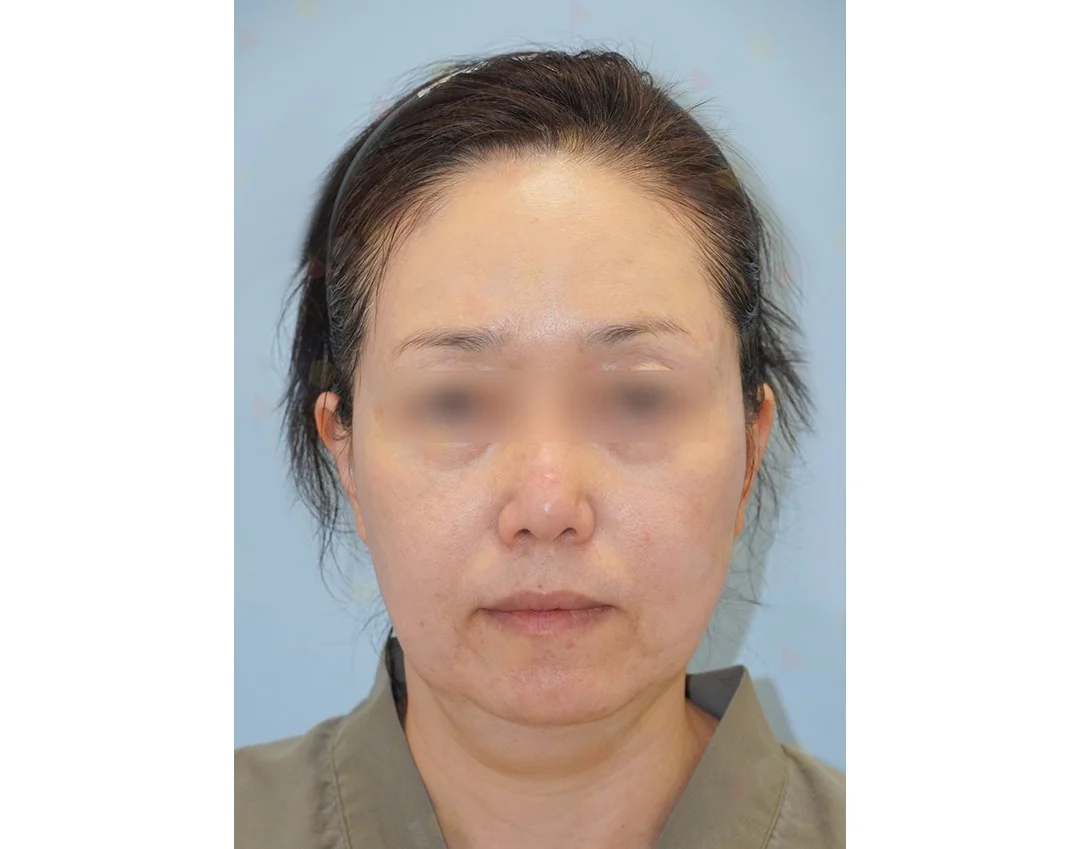 Asian woman before 345 plastic surgery procedure where natural results are desired.
