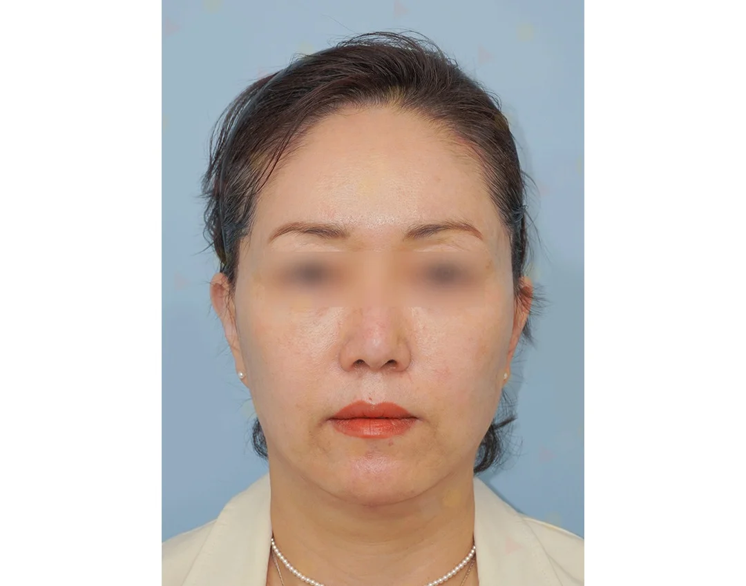 Asian woman before 345 Plastic Surgery for natural results. Facial rejuvenation.