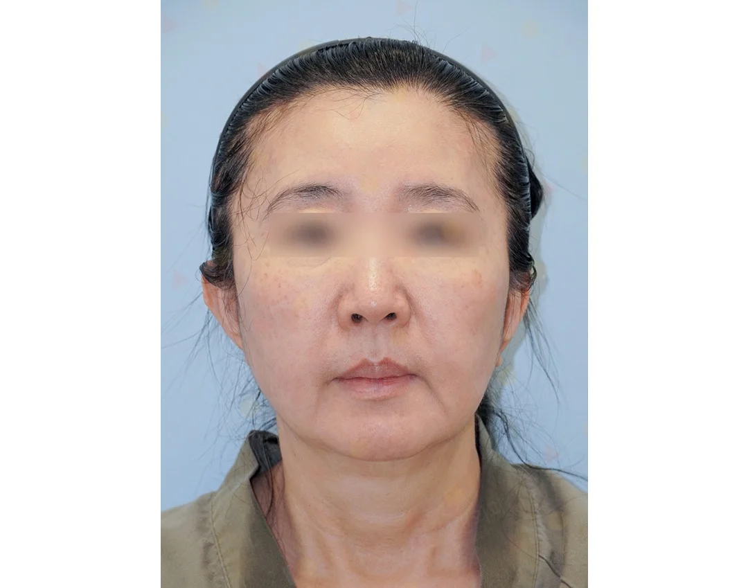Asian woman before 345 plastic surgery procedure where natural results are desired.