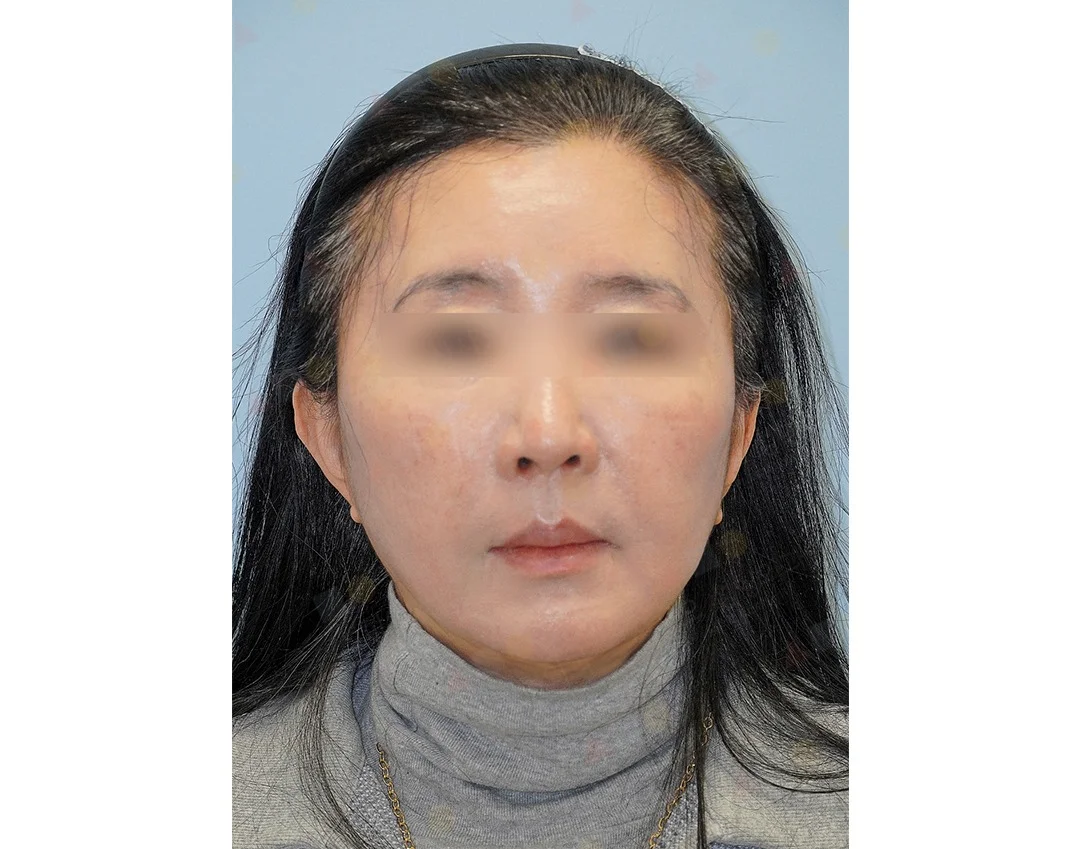 Asian woman before 345 plastic surgery procedure for natural results