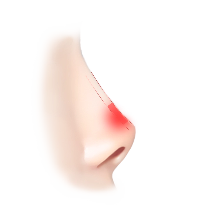 Nose plastic surgery illustration showing natural results. 345 Plastic Surgery where natural.