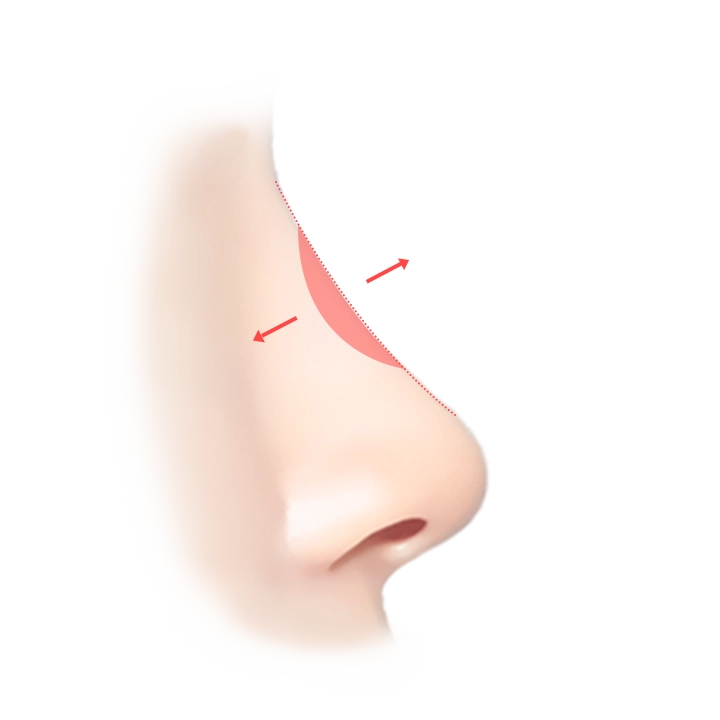 345 Plastic Surgery illustration showing natural facial reshaping with arrows.
