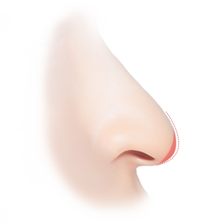 Nose plastic surgery illustration showing natural 345 plastic surgery results.