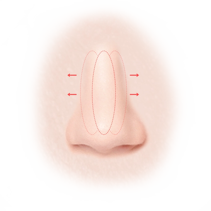 Nose plastic surgery diagram showing natural results 345 Plastic Surgery