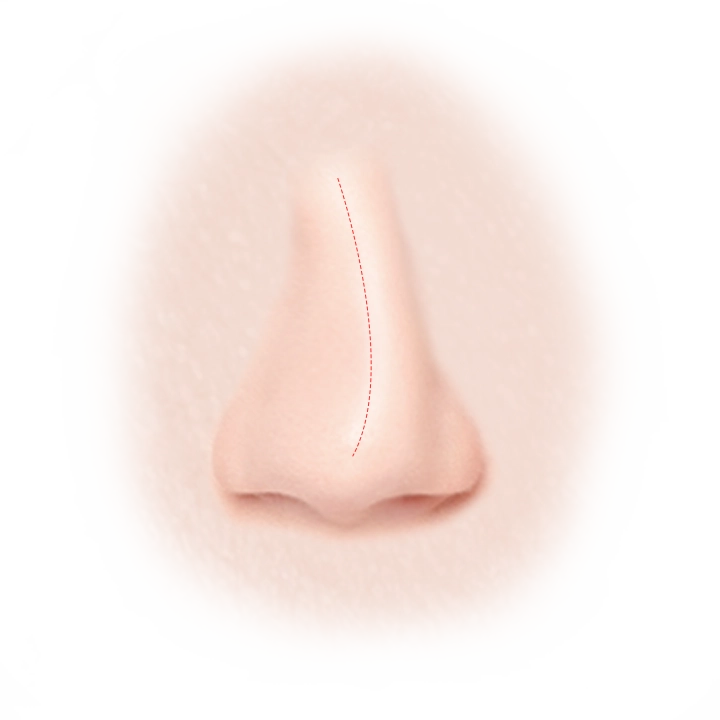 Nose with dotted line for plastic surgery where natural 345 plastic surgery
