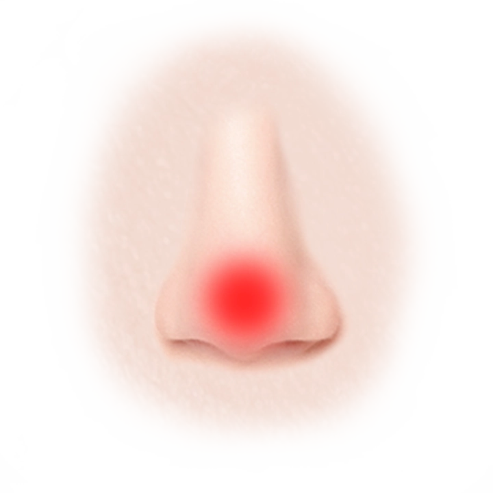 Nose with redness for 345 Plastic Surgery where natural looking results.
