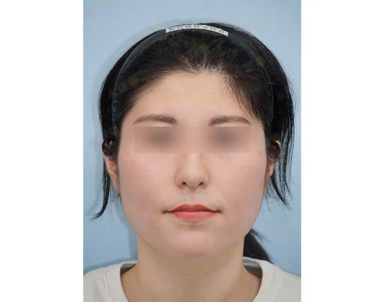 Asian woman before 345 plastic surgery where natural face cosmetic procedure