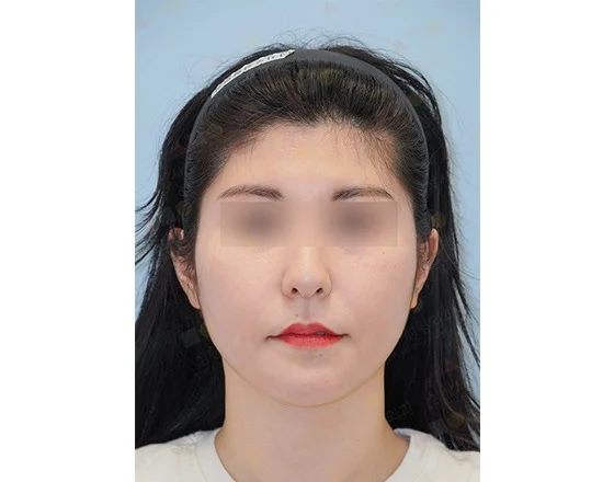 Asian woman face before 345 plastic surgery where natural, eyes blurred.