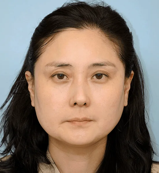 Asian woman face 345 plastic surgery where natural results. Cosmetic procedure example.