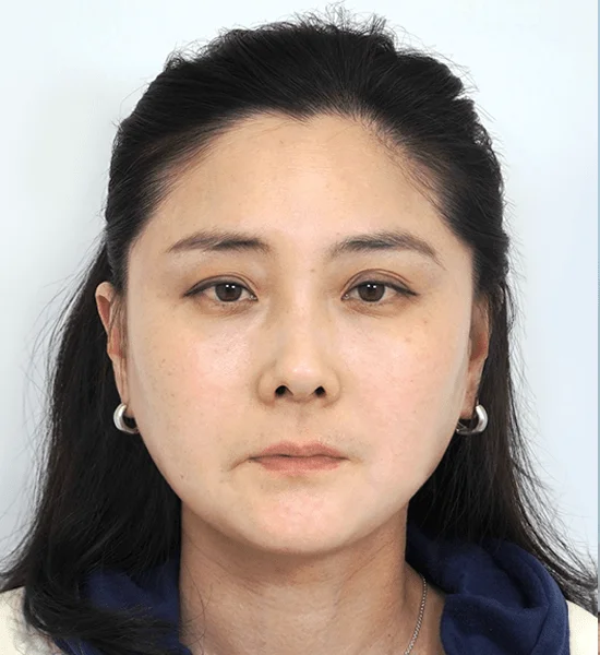 Asian woman face before plastic surgery for natural results 345 Plastic Surgery